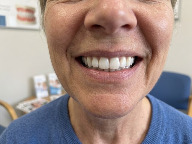 Blanqueamientos dentales en Lalín