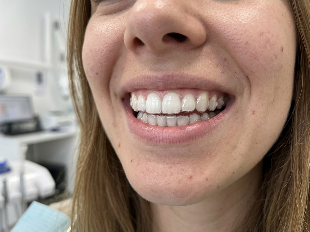 Foto 1 Ortodoncia invisible en Lalín: tratamientos discretos y cómodos