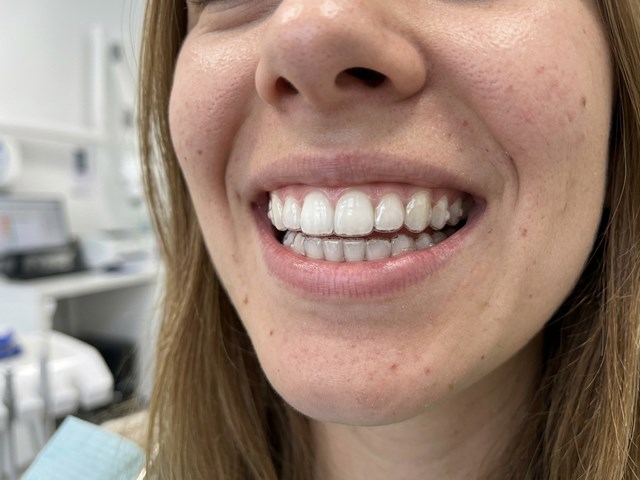 Ortodoncia invisible en Lalín: tratamientos discretos y cómodos